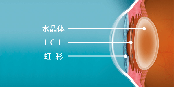 ICLとは
